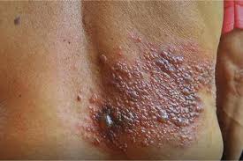 Herpes Zóster: cómo puede ayudarte la fisioterapia a aliviar el dolor